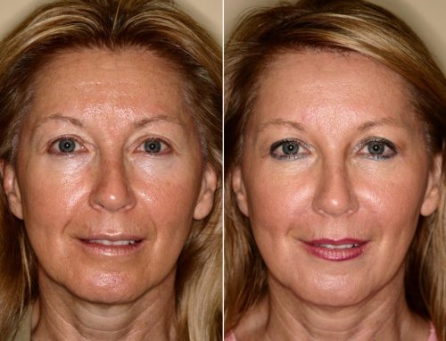 کاربردهای-مزوتراپی کاربردهای-مزوتراپی